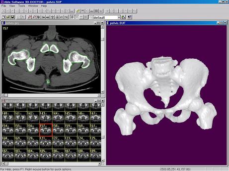 Wygląd kości miednicy w programie 3D Doctor