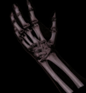 Rendering objętości - ręka - 3D Doctor